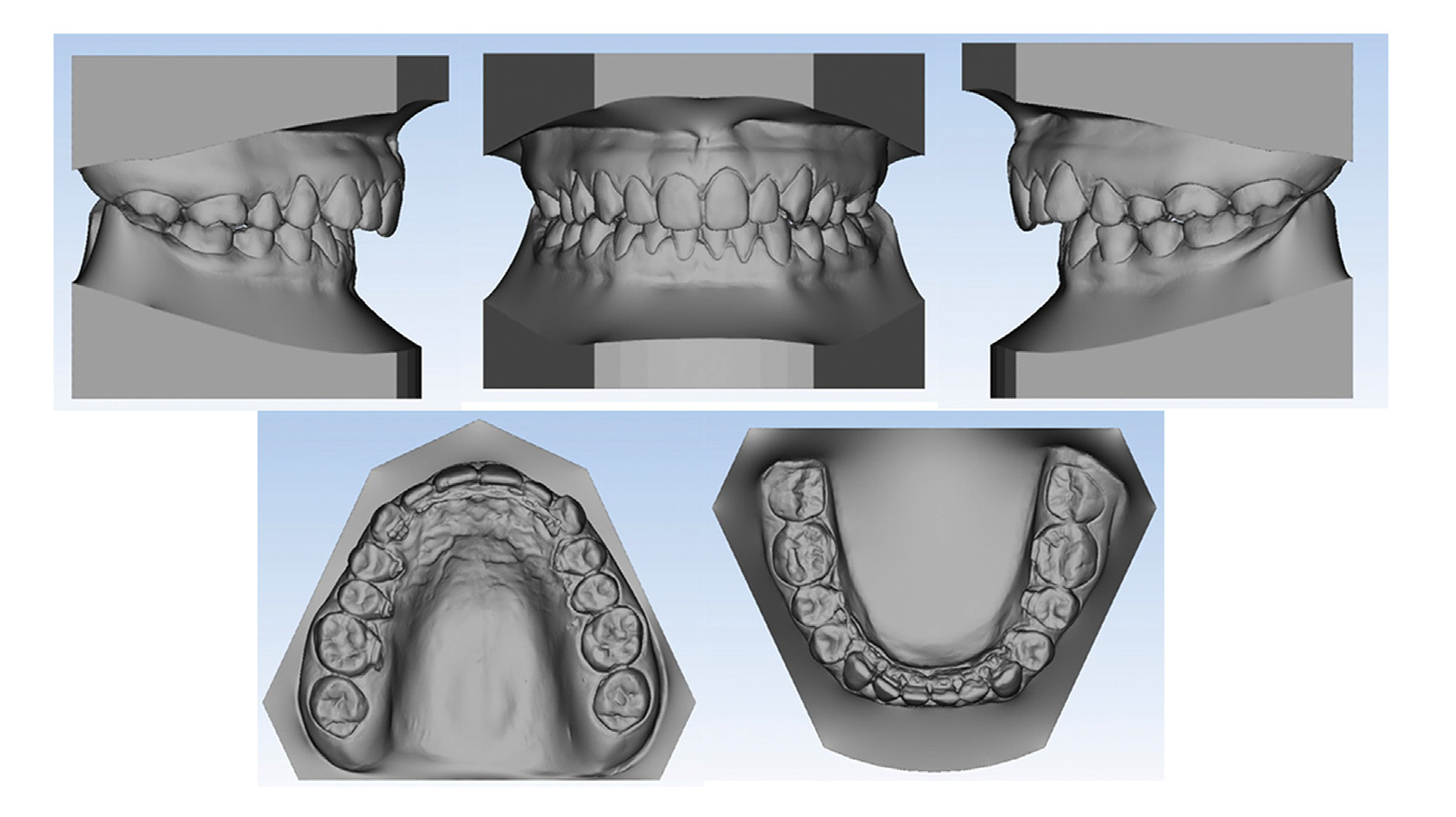 Treatment of Class II malocclusion with a customized lingual appliance