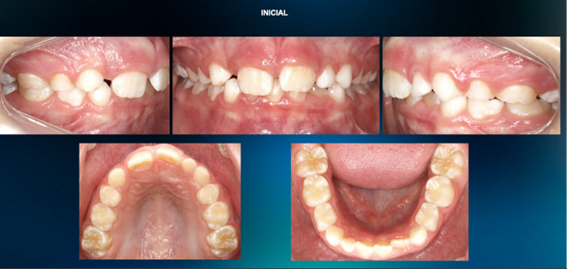 invisalign1