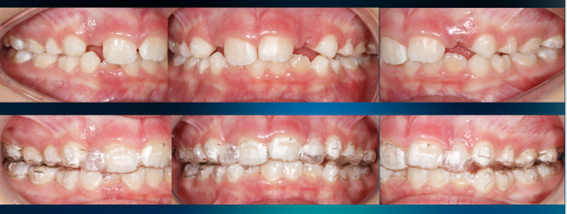invisalign2
