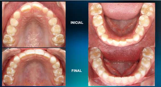 invisalign3