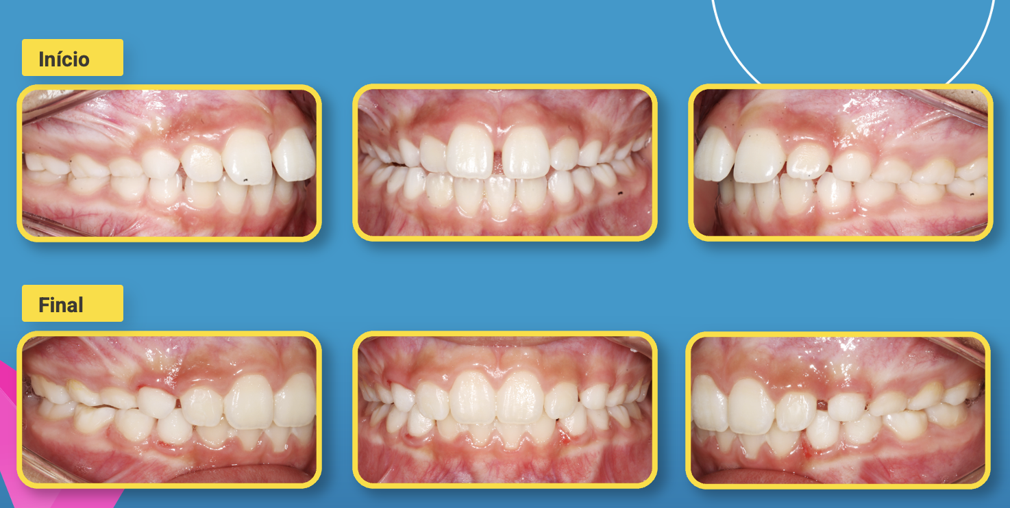InvisalignFirst2