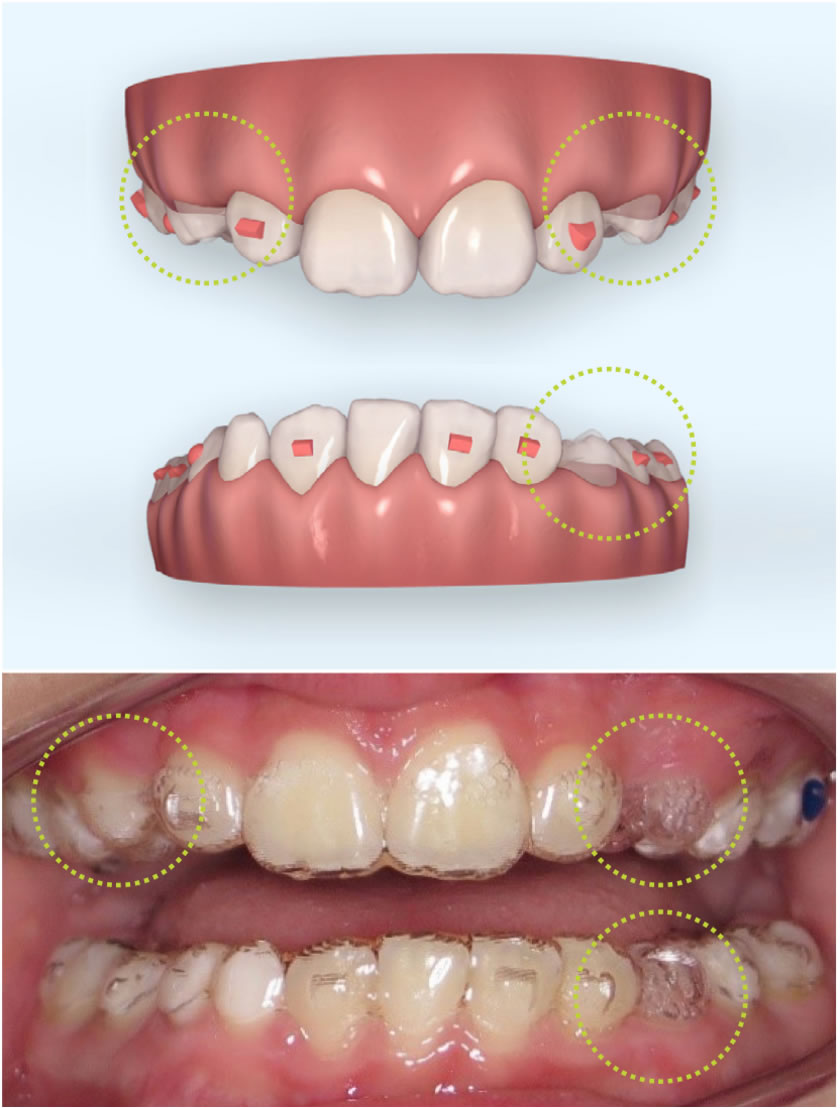 InvisalignFirstImage1