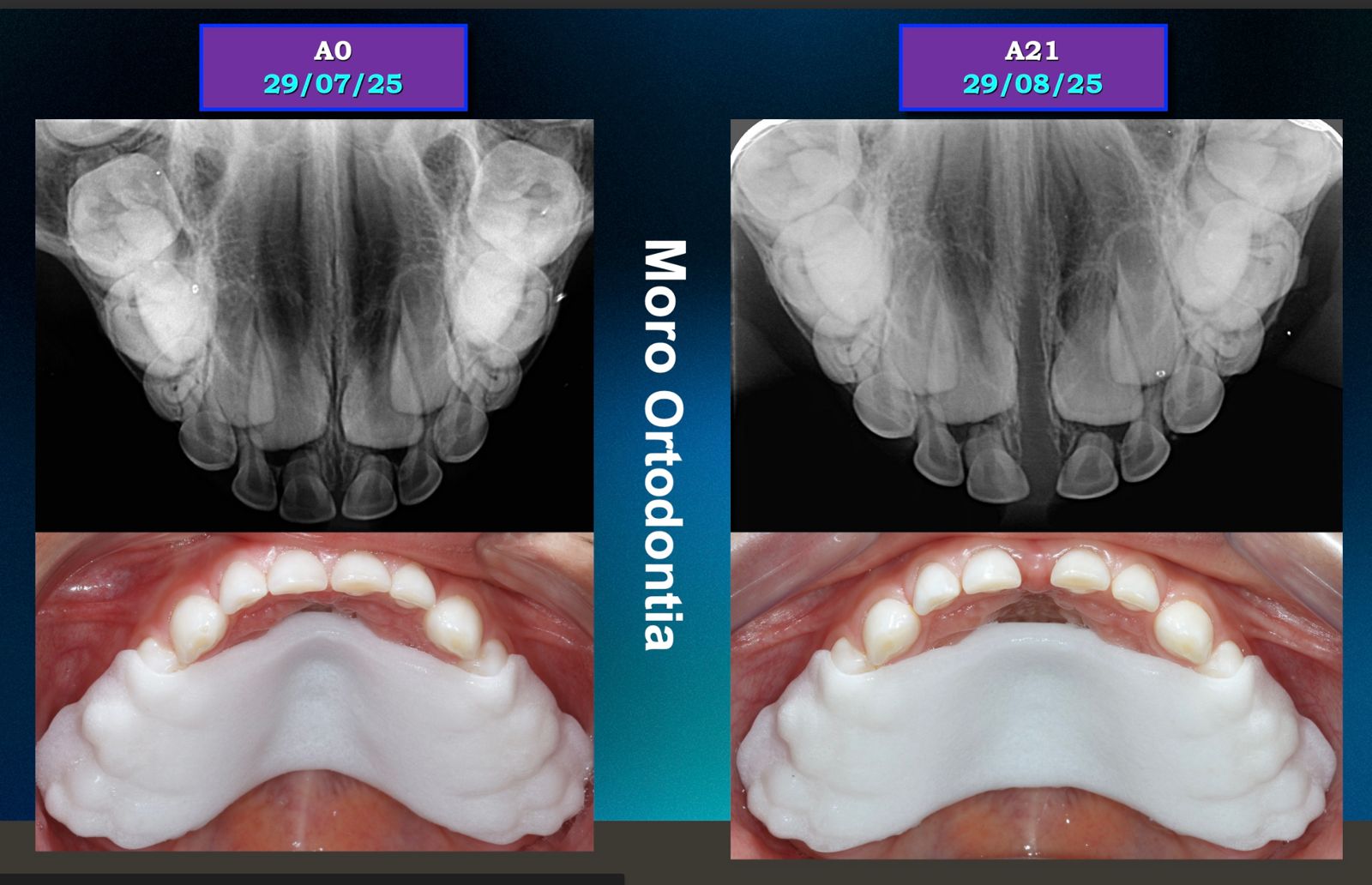 Palatal1