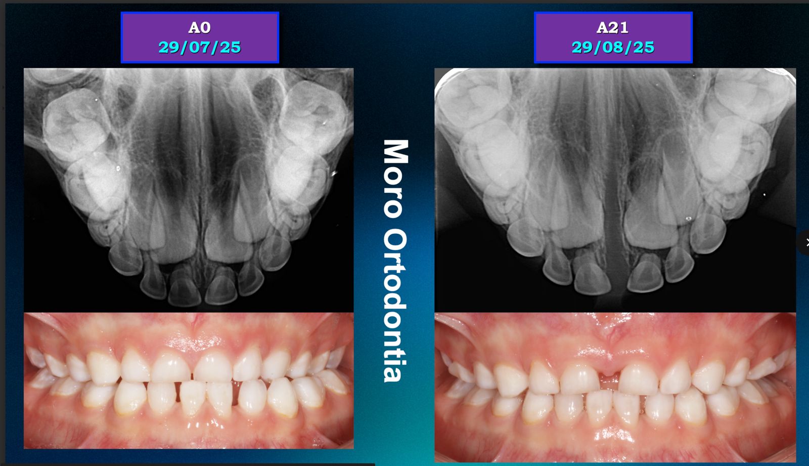 Palatal2