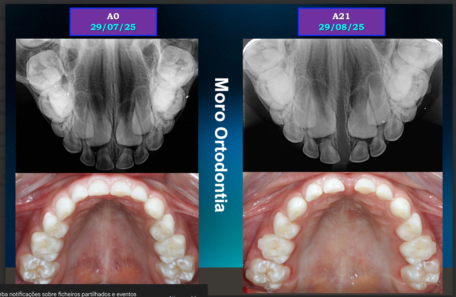 Palatal3