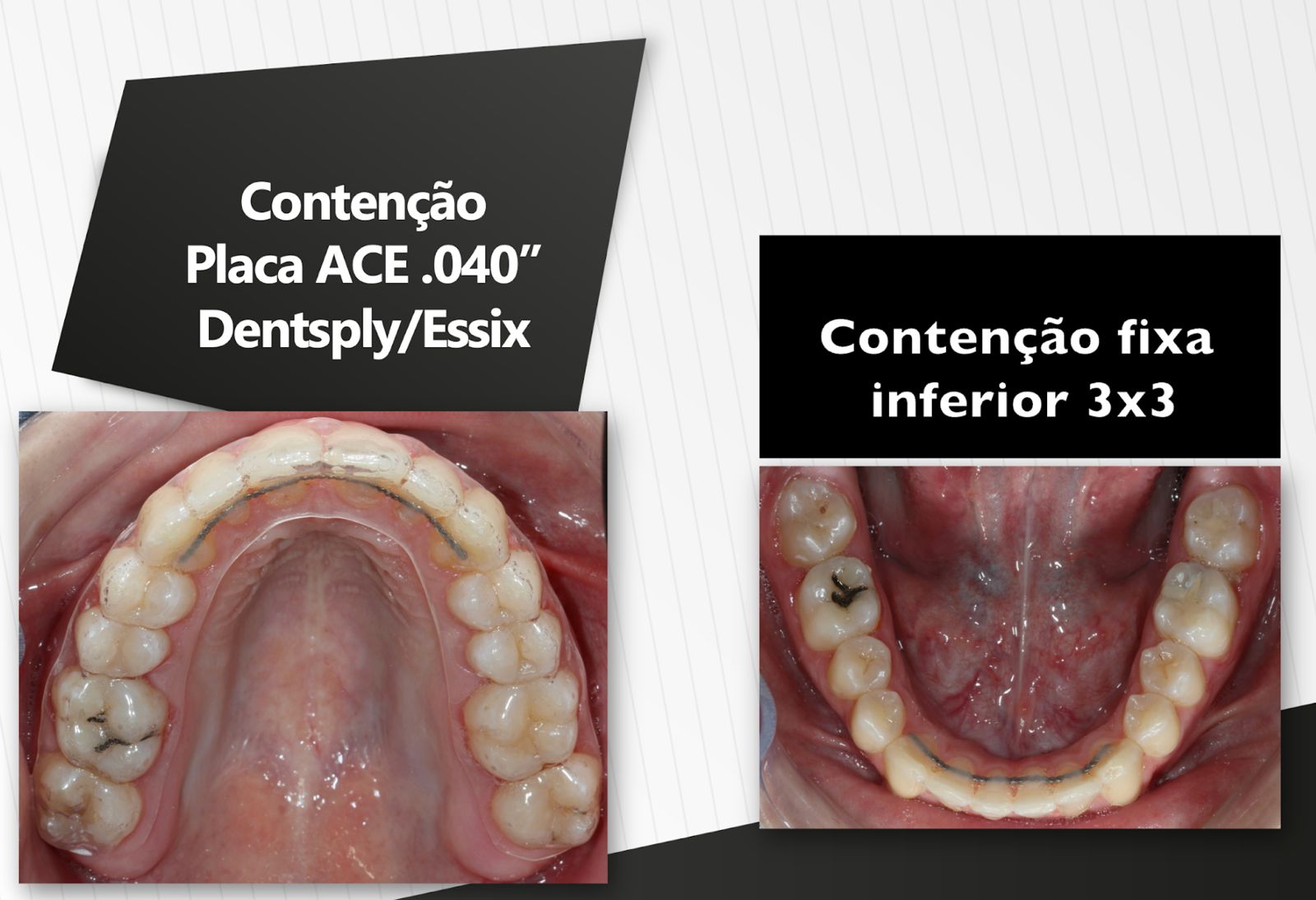 TiposContencao
