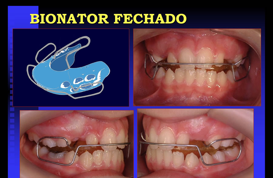 Bionator fechado