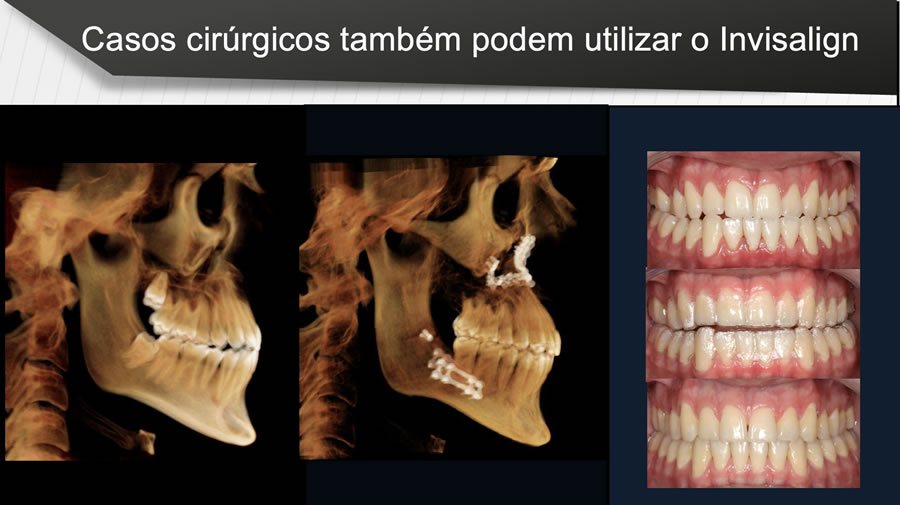 Caso tratado com Invisalign