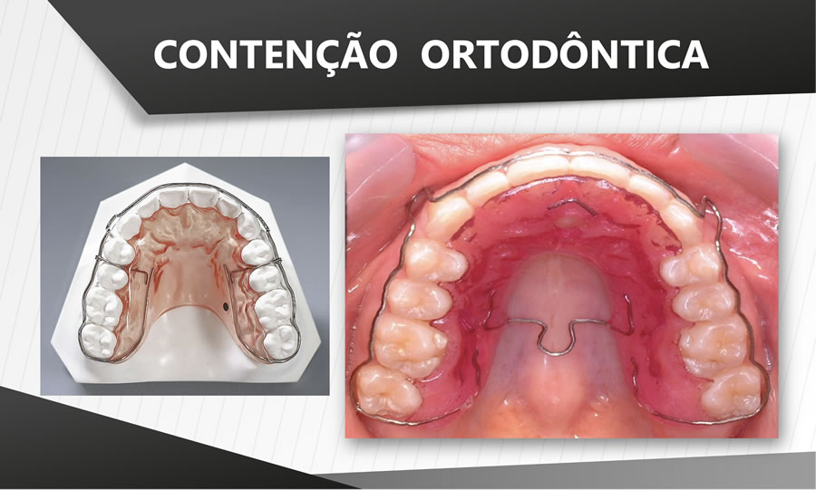 Contenção superior