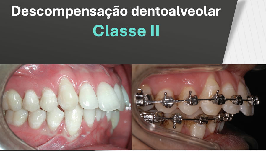 Descompensação da Classe II