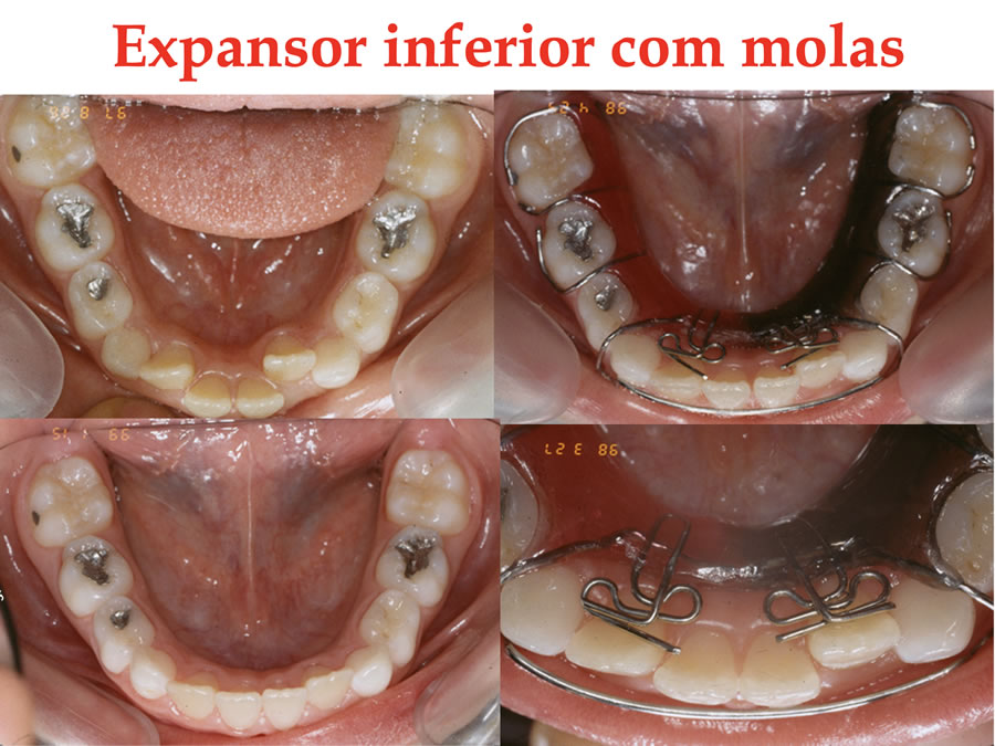 Expansor inferior com molas