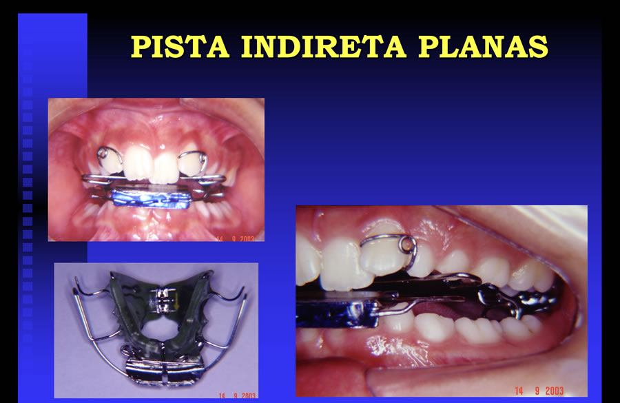 Pista Indireta Planas