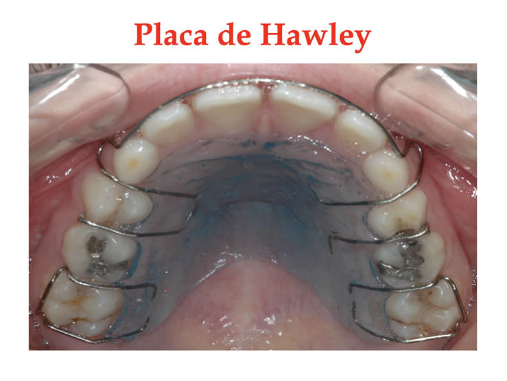 Placa de Hawley