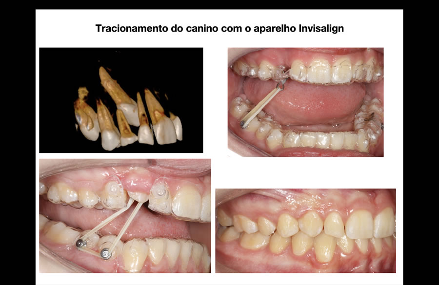 Tracionamento com Invisalign