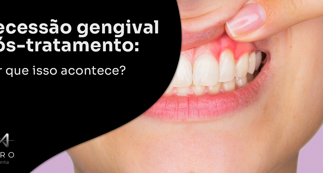 Recessão gengival pós-tratamento: por que isso acontece?