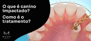 O que é canino impactado? Como é o tratamento?