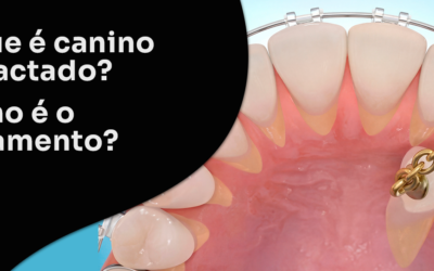 O que é canino impactado? Como é o tratamento?