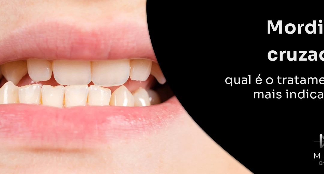 Mordida cruzada: qual é o tratamento mais indicado?