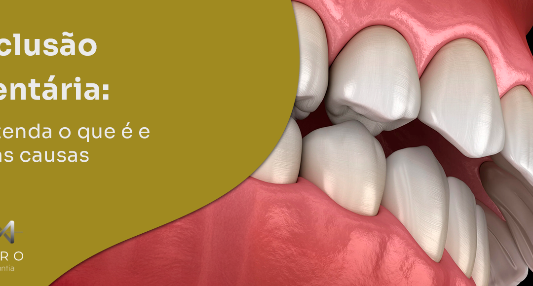 Oclusão dentária: entenda o que é e suas causas