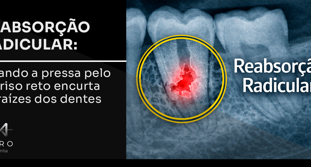 Reabsorção radicular: quando a pressa pelo sorriso reto encurta as raízes dos dentes