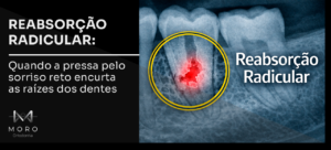 Reabsorção radicular: quando a pressa pelo sorriso reto encurta as raízes dos dentes
