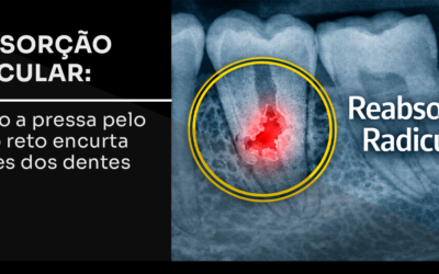 Reabsorção radicular: quando a pressa encurta as raízes