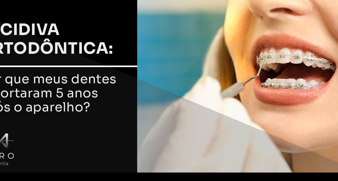 Recidiva ortodôntica: por que meus dentes entortaram 5 anos após o aparelho?