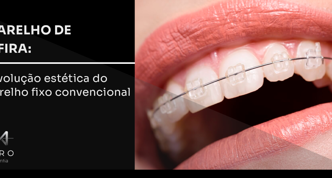 Aparelho de Safira: a evolução estética do aparelho fixo convencional