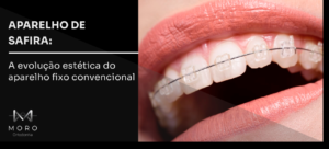 Aparelho de Safira: a evolução estética do aparelho fixo convencional