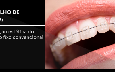Aparelho de Safira: a evolução estética do aparelho fixo convencional