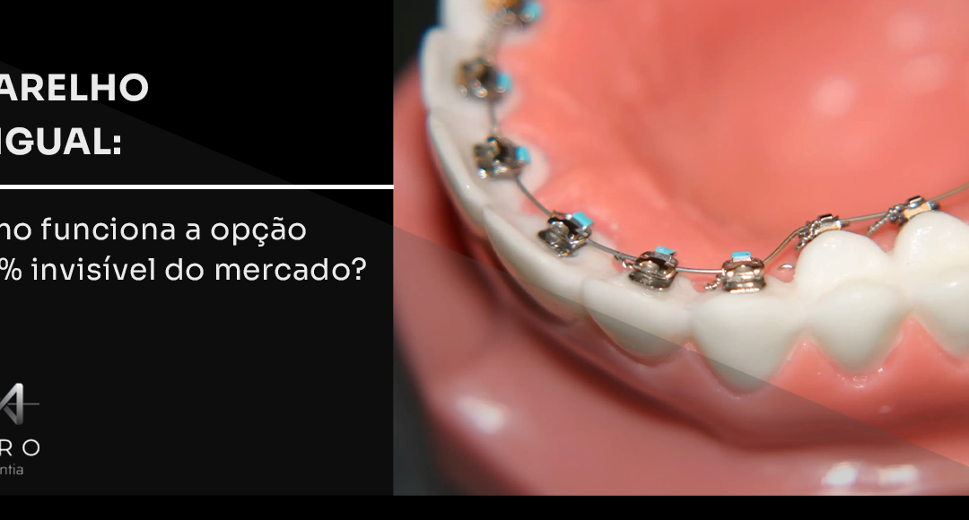 Aparelho lingual: como funciona a opção 100% invisível do mercado?