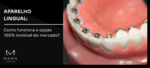 Aparelho lingual: como funciona a opção 100% invisível do mercado?