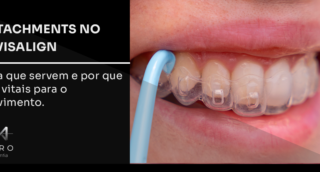 Attachments no Invisalign: para que servem e por que são vitais para o movimento