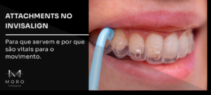 Attachments no Invisalign: para que servem e por que são vitais para o movimento