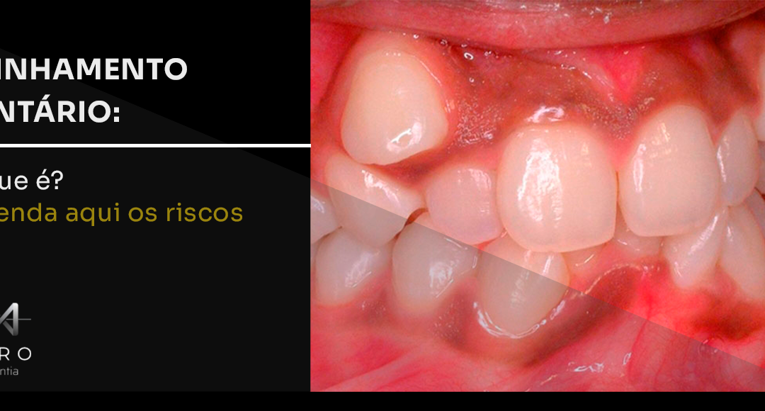 Apinhamento dentário: o que é? Entenda aqui os riscos