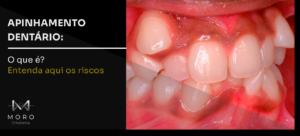 Apinhamento dentário: o que é? Entenda aqui os riscos