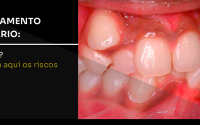 Apinhamento dentário: o que é? Entenda aqui os riscos