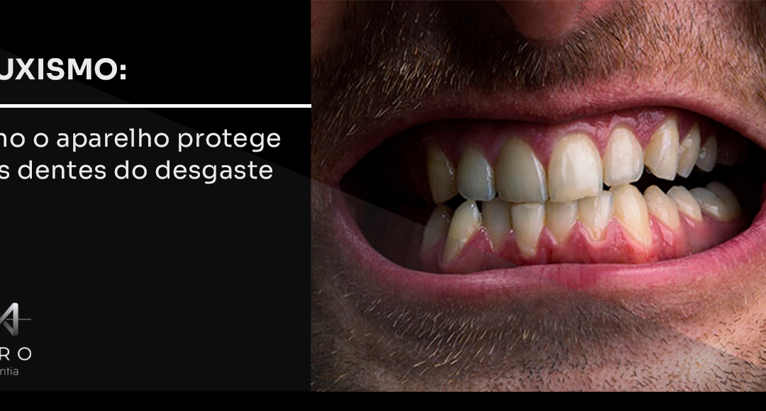 Bruxismo: como o aparelho protege seus dentes do desgaste
