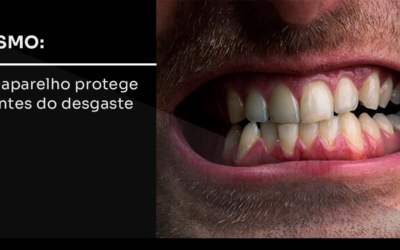Bruxismo: como o aparelho protege os dentes do desgaste?