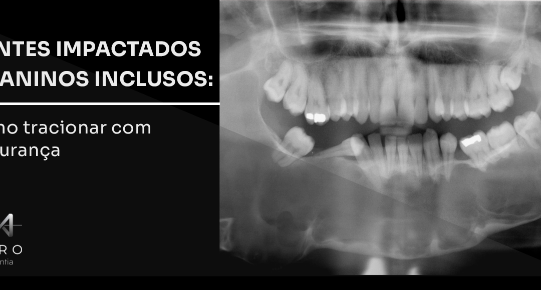 Dentes impactados e caninos inclusos: como tracionar com segurança