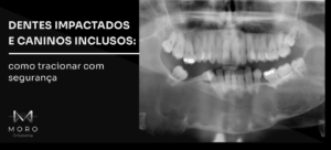 Dentes impactados e caninos inclusos: como tracionar com segurança