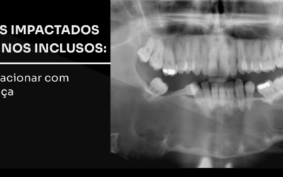 Dentes impactados e caninos inclusos: como tracionar com segurança