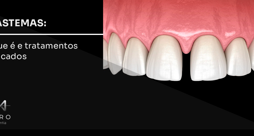 Diastemas: o que é e tratamentos indicados