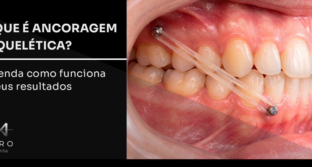 O que é ancoragem esquelética? Entenda como funciona e seus resultados