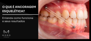 O que é ancoragem esquelética? Entenda como funciona e seus resultados