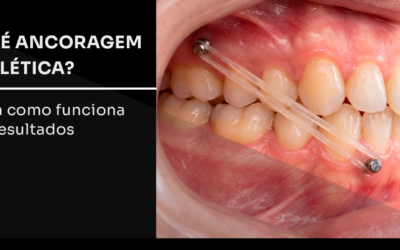O que é ancoragem esquelética? Entenda como funciona e os resultados