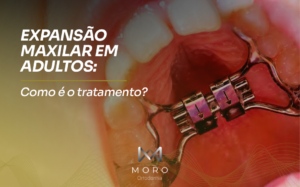 Expansão maxilar em adultos: como é o tratamento?