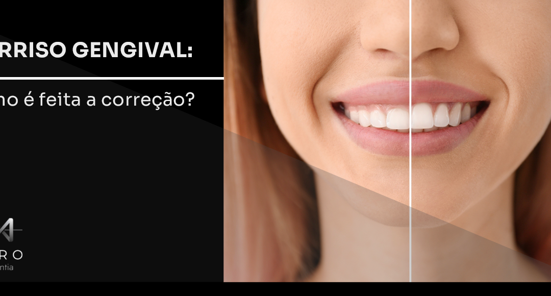 Sorriso gengival: como é feita a correção?