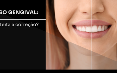 Sorriso gengival: como é a correção? | Moro Ortodontia