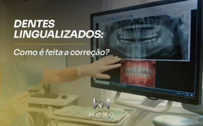 Dentes lingualizados: como é feita a correção? | Moro Ortodontia